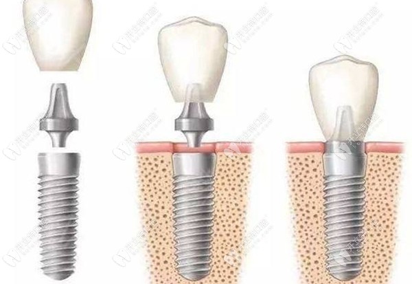 种植牙的植入过程www,kelete.com