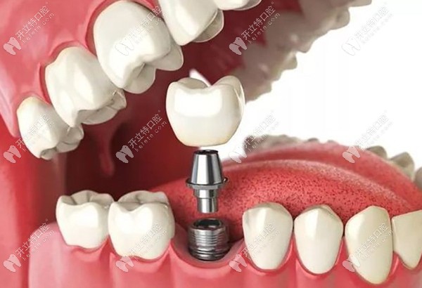种植牙植入过程图