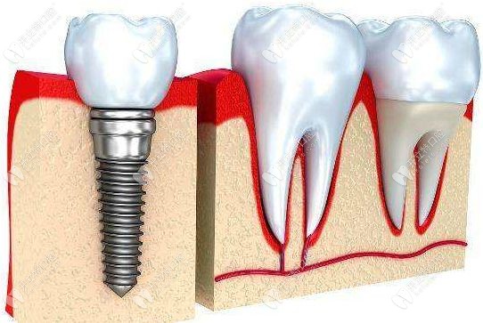 荔湾区口腔医院单颗种植牙价格