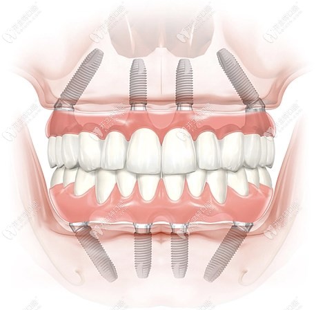 全口种植牙图