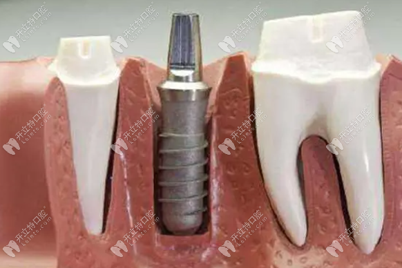 kelete.com打孔是种植牙过程中关键的一步