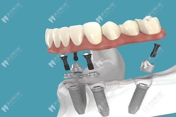 All-on-4种植牙技术kelete.com