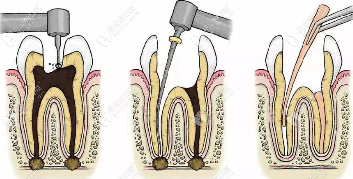 根管治疗三次哪次比较疼?第2次抽牙髓和第3步根管填充较疼