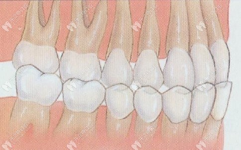 怎么判断地包天是骨性还是牙性?来看牙性,骨性地包天对比照