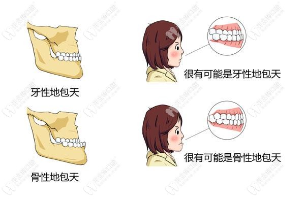 地包天牙性和骨性的对比照