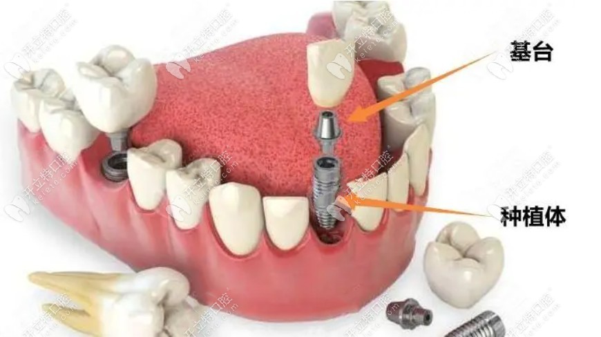 半口4颗种植牙能做固定修复吗?可以,allon4半口种植牙价格4万+