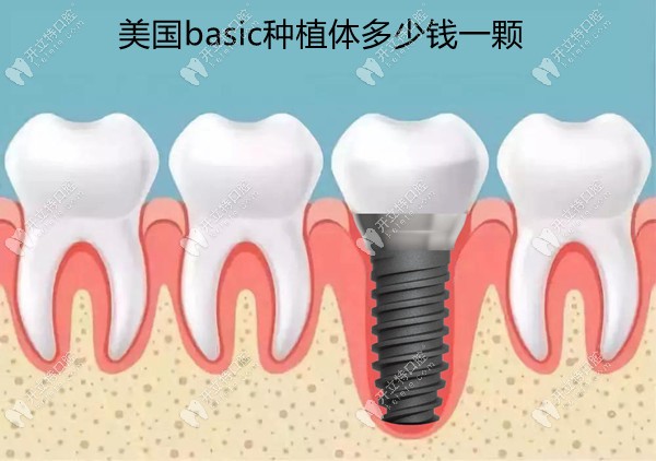 美国basic种植体多少钱?8000元起的欧妮泰种植牙型号多,质量好