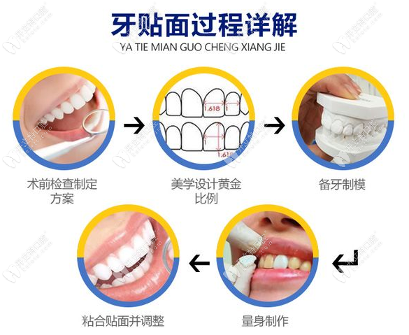 美加贴面和emax贴面区别www.kelete.com