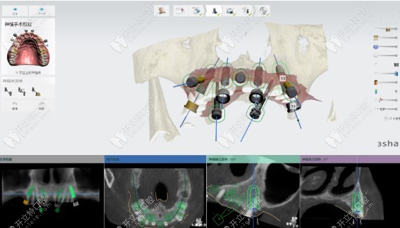 3D数字化种植牙