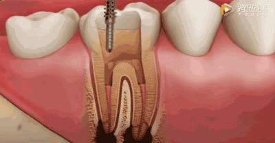 深圳牙齿根管治疗费用是多少钱一颗