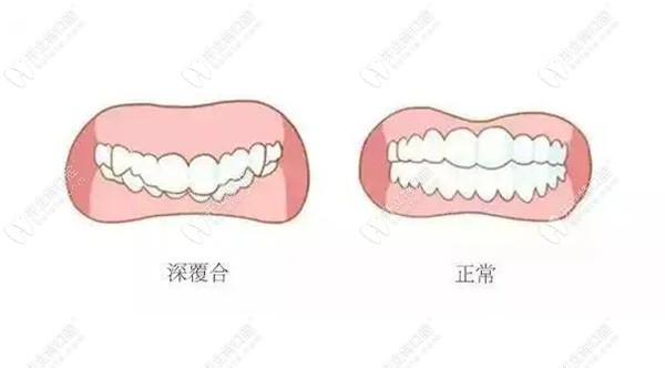 成都深覆合矫正牙齿医院排名前十