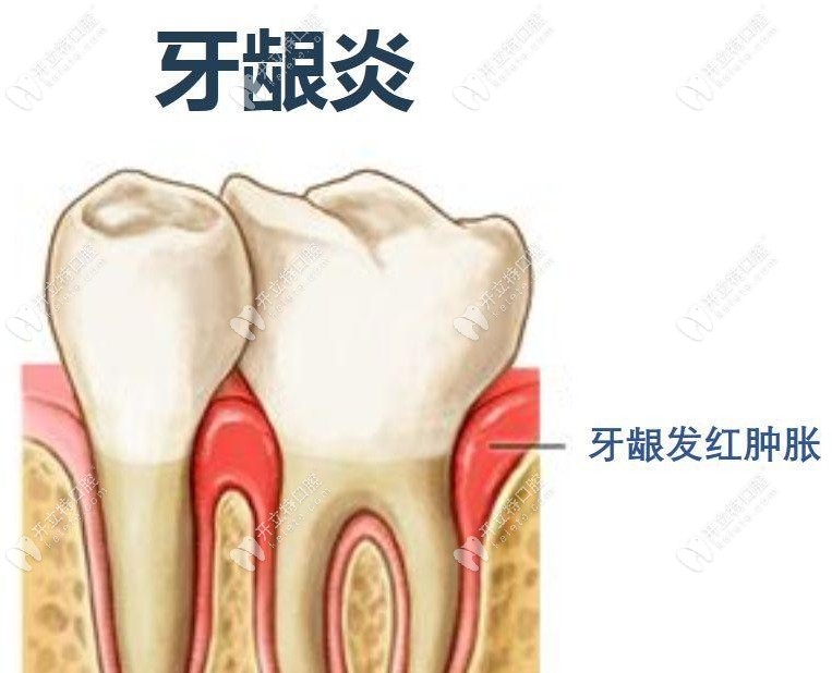 牙龈炎的症状是什么