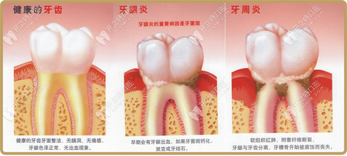 牙龈炎还是牙周炎的区别表现在哪里