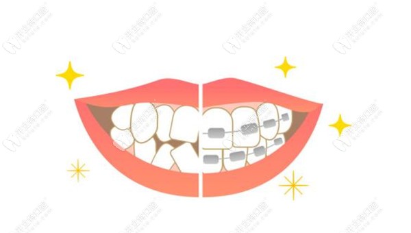 成都极光口腔10月牙齿矫正优惠详情