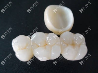牙冠怎样安装在牙齿上?全瓷牙冠的安装过程及视频可了解