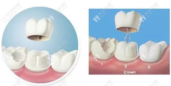 全瓷牙冠的安装过程kelete.com