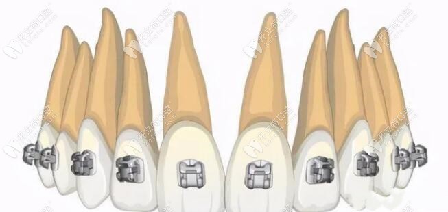 奧美科金屬自鎖牙套價格：美國Ormco費用1.5萬/Damon價格1.8萬起