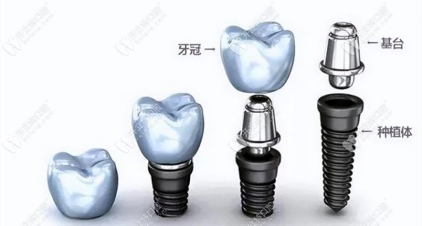 衡水单颗种植牙2025价格表