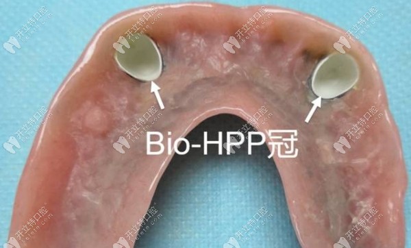 德国HPP义齿优缺点