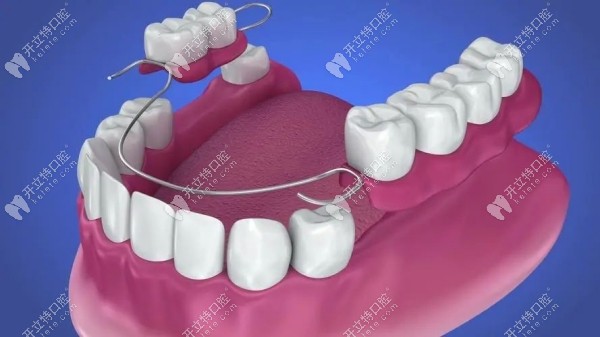 維他靈活動牙是什么材質的?生物合金材質,質量好/舒服度高