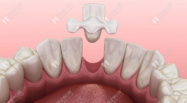 马里兰桥不需要磨两边牙,但对两边牙齿有危害且使用寿命短