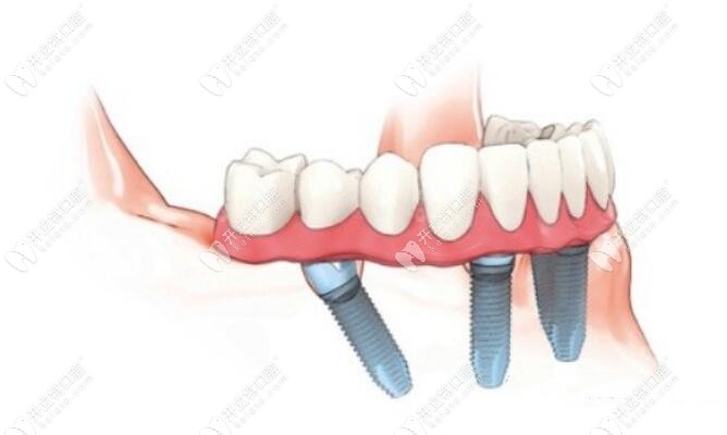 半口种植牙修复
