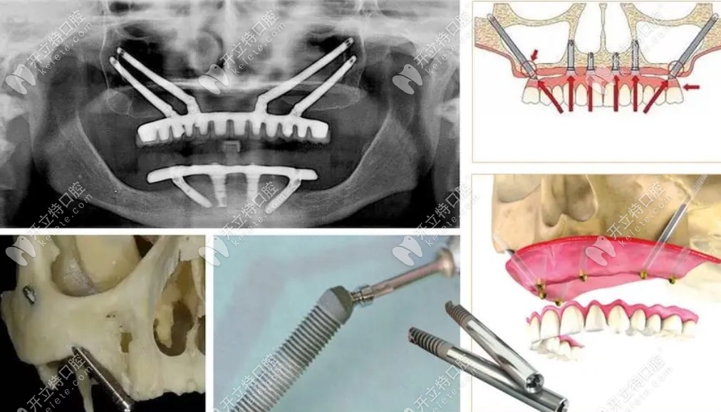 穿颧穿翼种植牙ct和示意图kelete.com