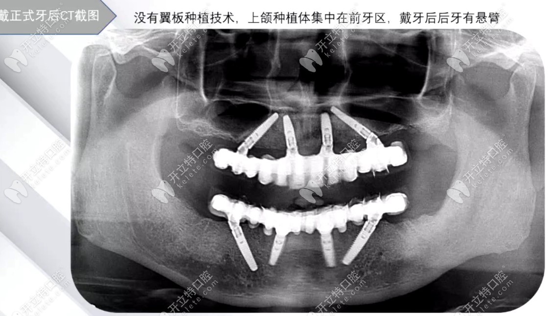 allon4全口种植牙ct照