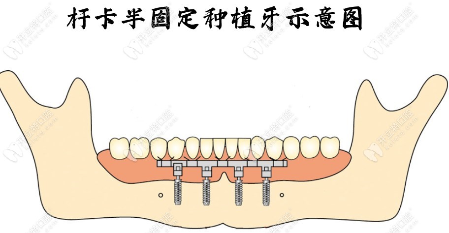 杆卡半固定种植牙