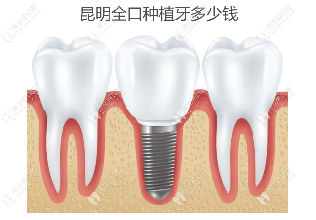 昆明全口种植牙多少钱,满口种植牙价格4万元起(美奥/柏德等)