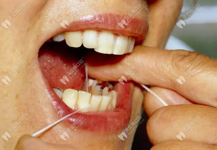 牙齿松动的图www.kelete.com