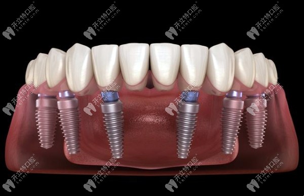 全口即刻种植牙价格