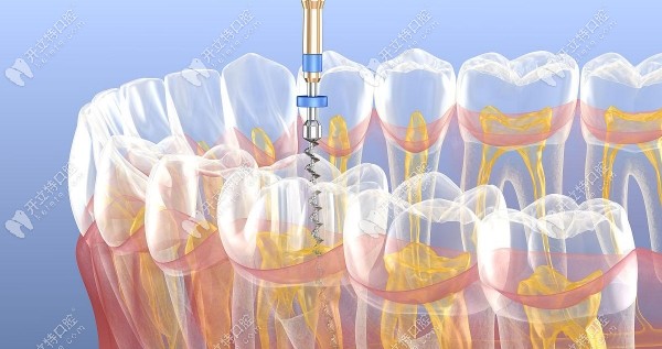 牙根外露做根管治疗可以保留