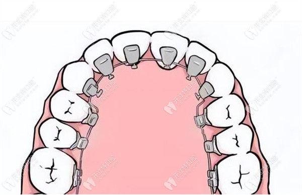 许昌牙齿矫正价格