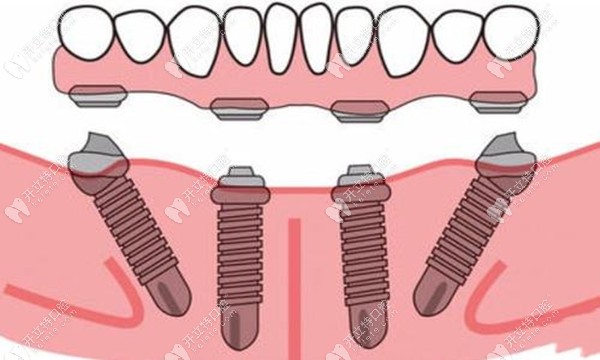 allon4种植牙是固定修复方式