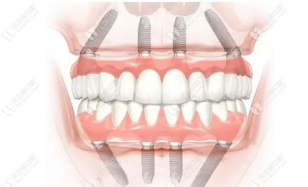 牙槽骨植骨手术可能出现的后遗症