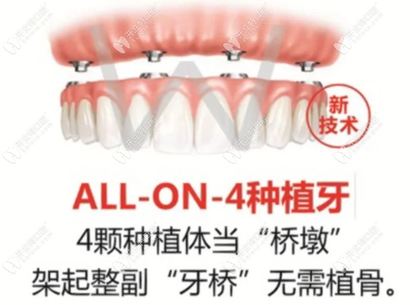 半口种植牙种4颗和6颗区别看完，我选择了更贵的allon6种植牙