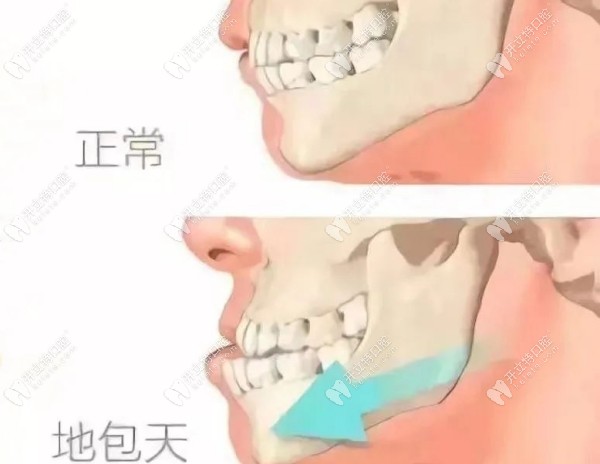 骨性地包天可以戴牙套正畸吗?轻微骨性地包天可以不用手术