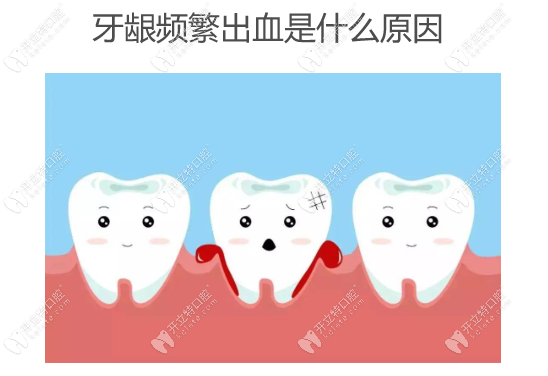 牙龈频繁出血是什么原因,牙龈出血4种原因:牙龈发炎...
