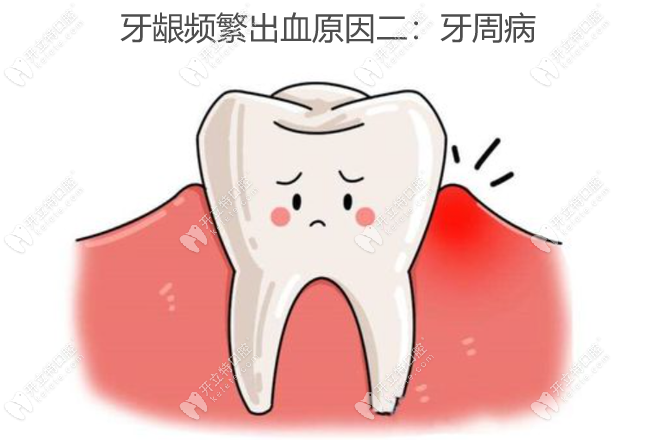 牙龈频繁出血是什么原因