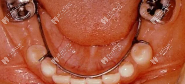 牙齿间隙保持器真的有必要吗www.kelete.com