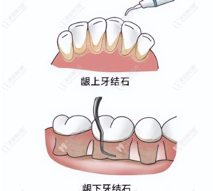 龈下刮治的意义与术后牙龈恢复