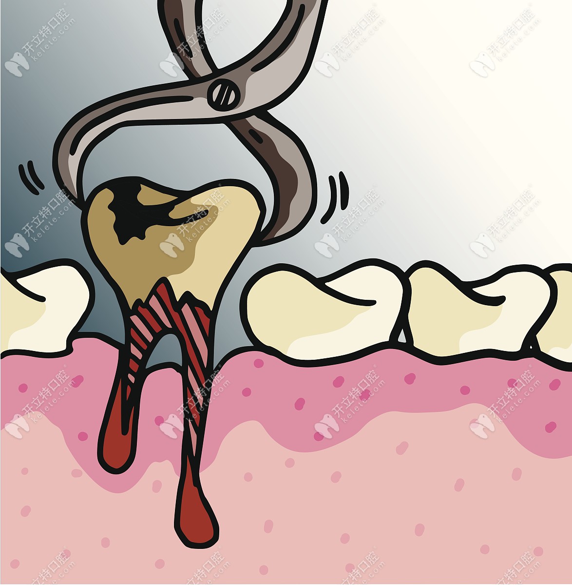 拔牙对牙髓炎的影响