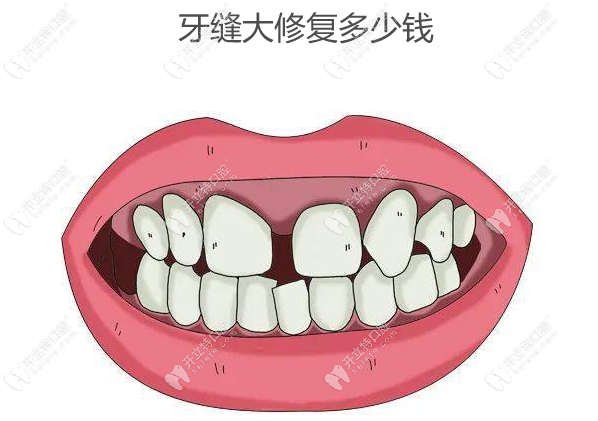 牙缝大修复多少钱www.kelete.com