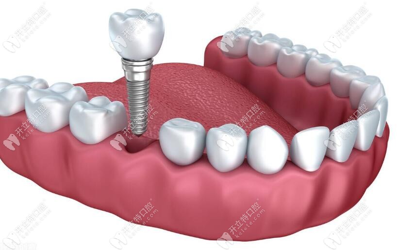 單顆種植牙修復(fù)技術(shù)kelete.com