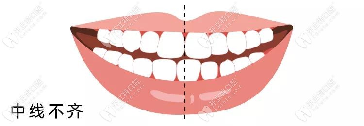 牙齿中线不齐脸在一定情况下会越来越歪