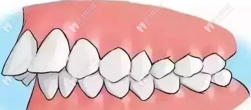 儿童大门牙外凸，医学上称为龅牙，确实需要提前矫正