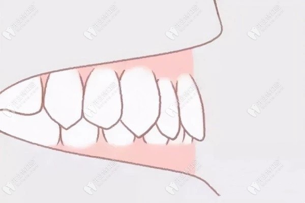 闭锁性深覆合是骨性还是牙性