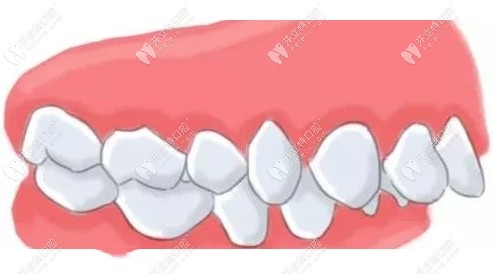 闭锁性深覆合适合用隐形矫正吗?牙性适合且不用做正颌手术