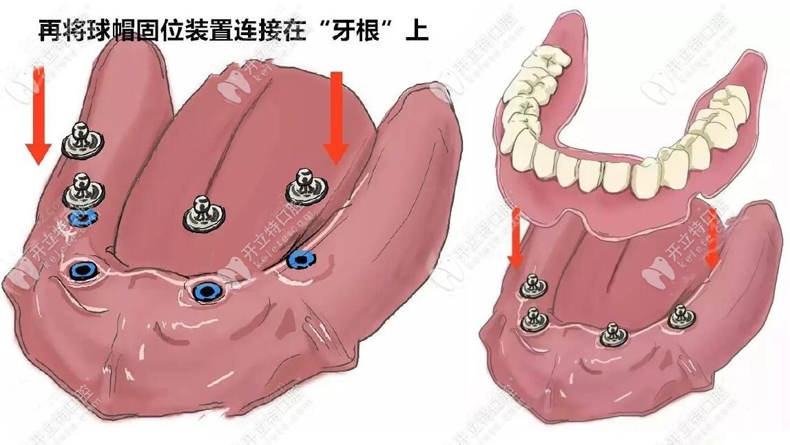 成都半口种植牙集采价格9999元起